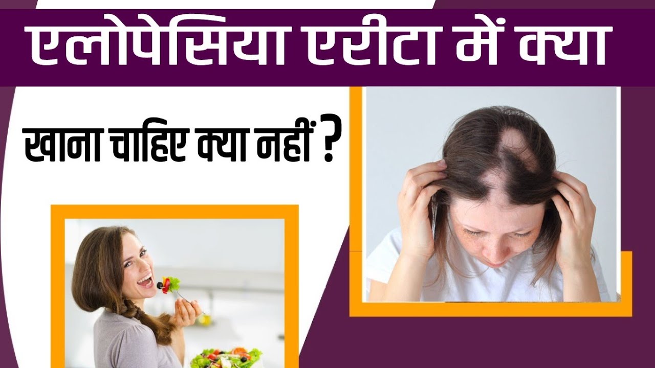 एलोपेसिया एरीटा में क्या खाना चाहिए क्या नहीं? What to eat and what not to eat in alopecia areata?