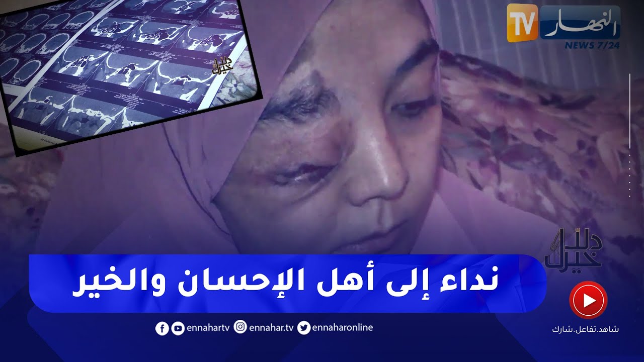 دلال خير: فتاة يتيمة مصابة بتشوه خلقي تطلب من أهل الإحسان والخير المساعدة في العلاج