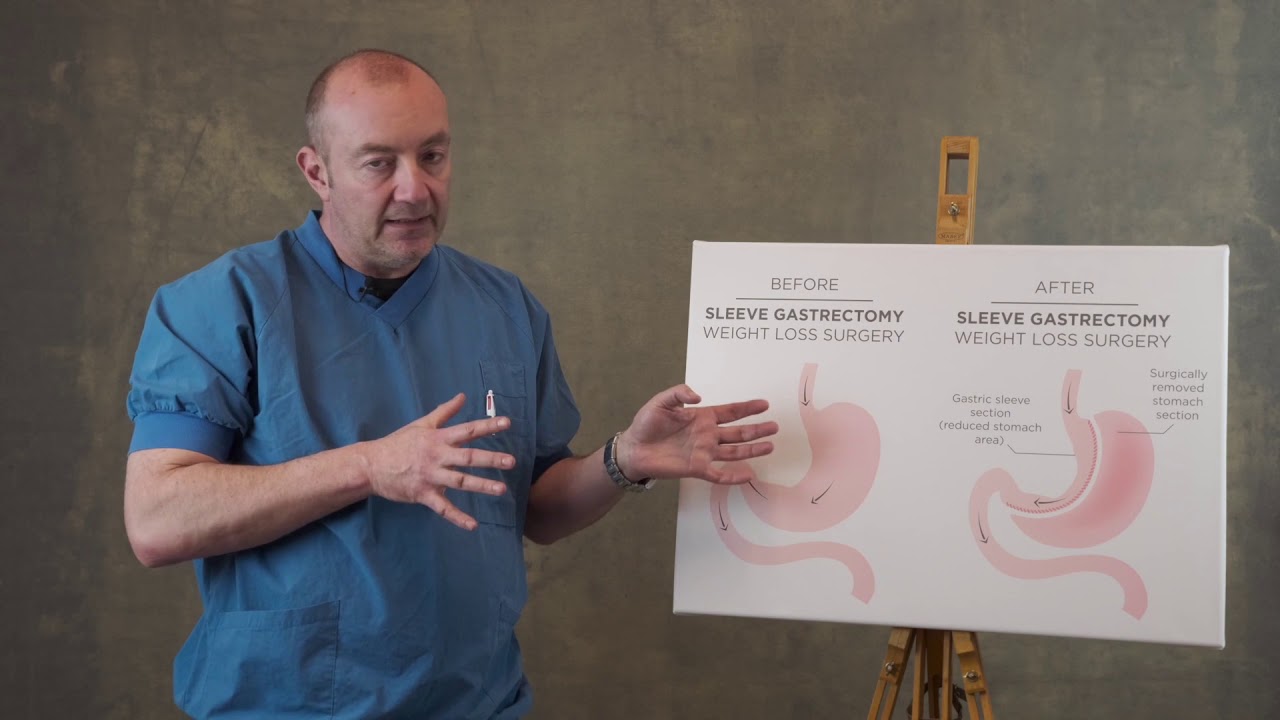 Gastric sleeve