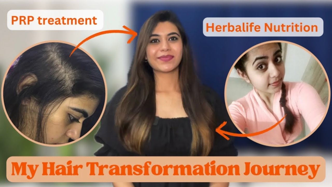 My Hair Transformation Journey | Herbalife Nutrition | PRP treatment | Minoxidil | Rosemary water