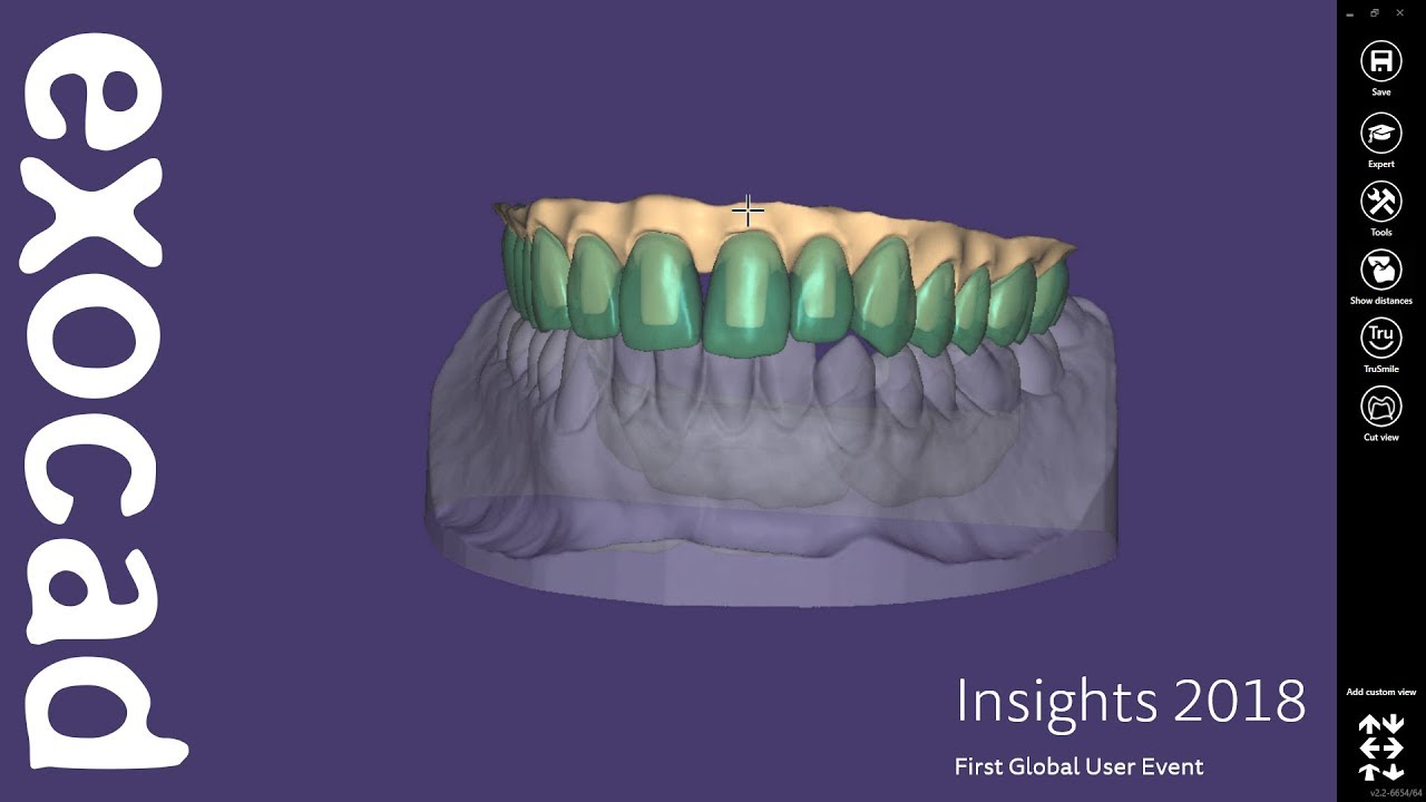INSIGHTS 2018: DentalCAD Case Demonstration - Thimble crown implant bridge