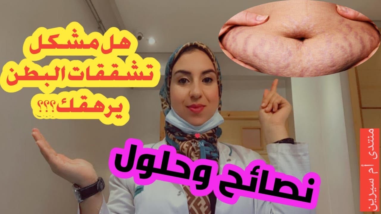 أفضل طرق الوقاية والعلاج من تشققات الحمل ✅🤰قبل وبعد الولادة ✅نصائح وحلول مع ام سيرين