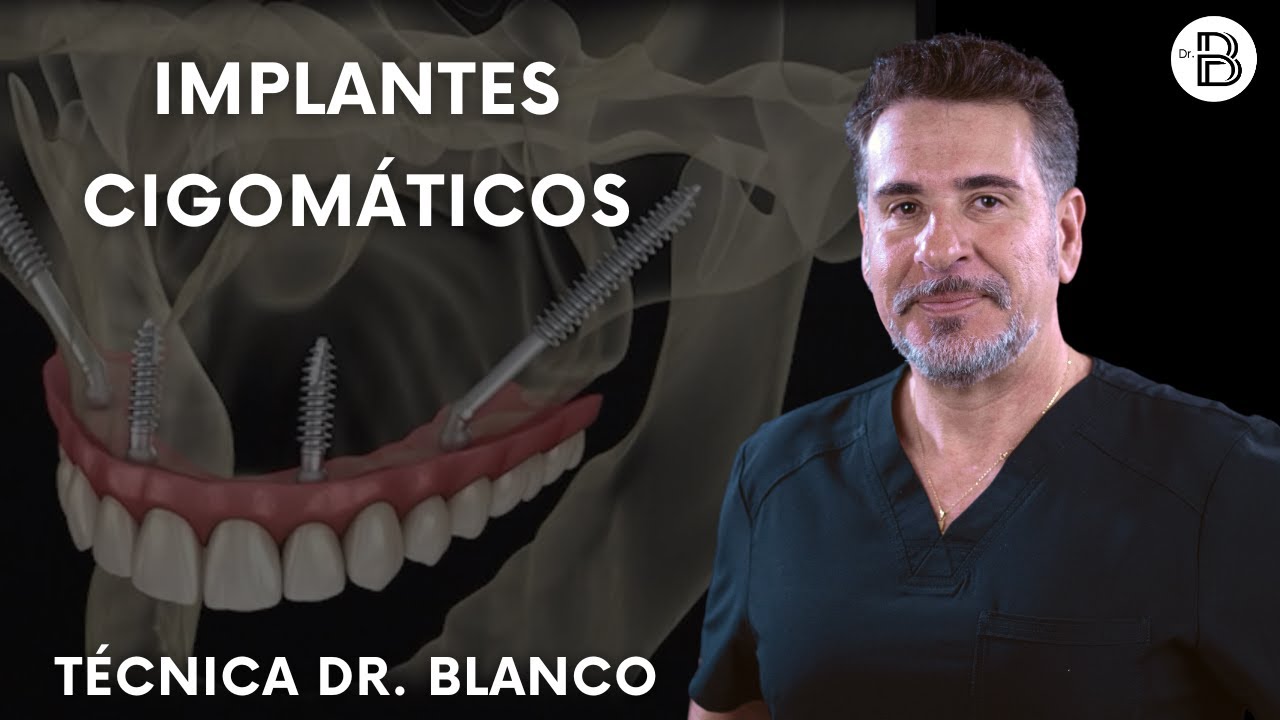 Implantes cigomáticos con la Técnica Dr. Blanco. Dientes fijos en 24 horas.
