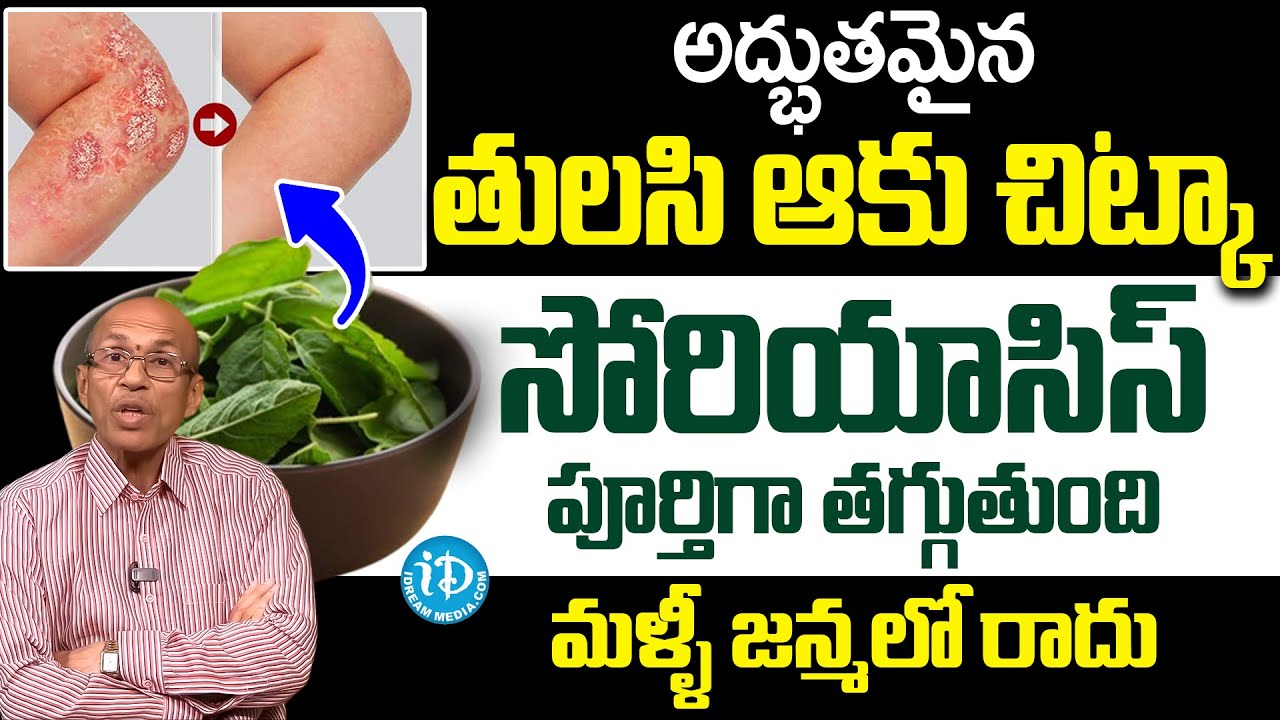 తులసి ఆకుతో సోరియాసిస్ పూర్తిగా తగ్గుతుంది..? | How to Prevent Psoriasis | Dr Madhusudhan Sharma
