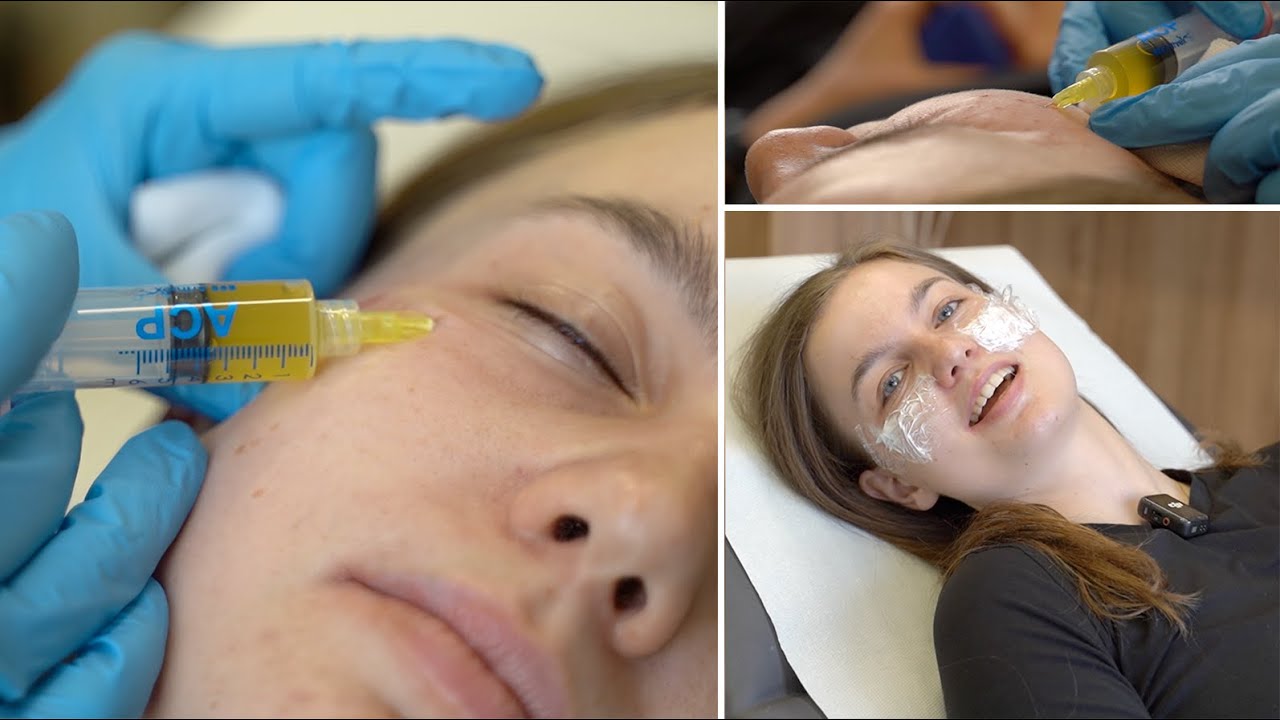 Facelift bez chirurga? Vyzkoušela jsem plazmaterapii 💉✨