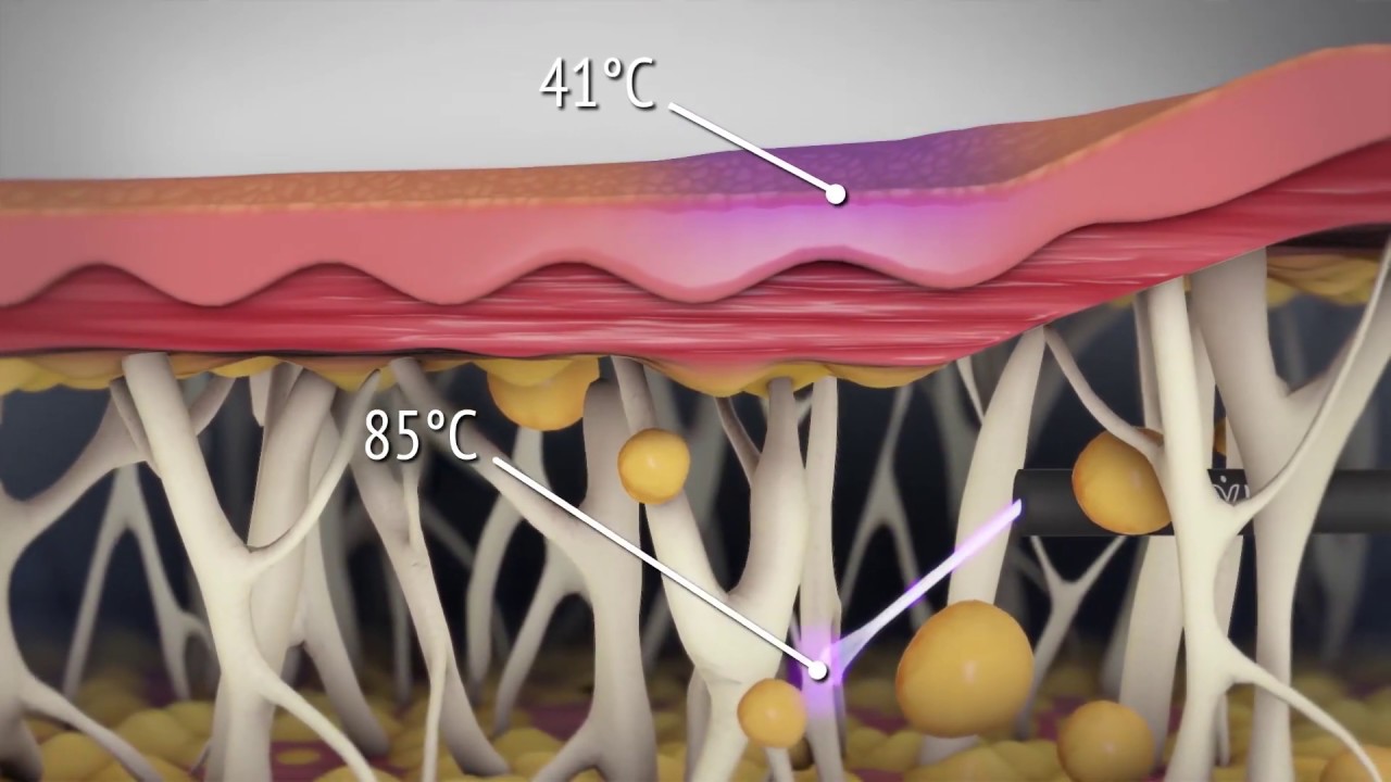 Schonende Hautstraffung mittels der neuen Renuvion® Helium-Plasmaenergie | Dr. Klöppel & Kollegen