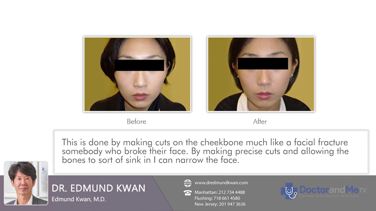 Experience the safe and skilled cheekbone reduction treatment by Dr. Kwan