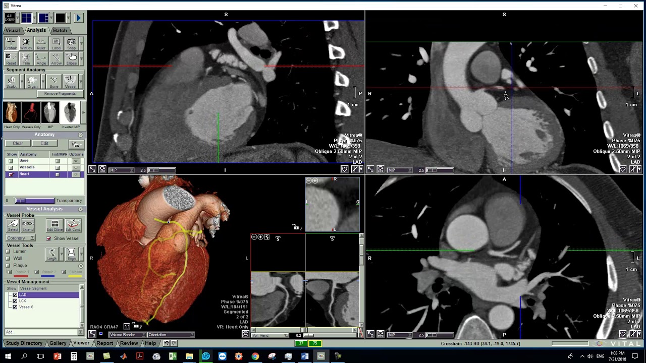 CORONARIES WITH VITREA TIPS AND TRICKS BY MOHAMMED GIBREEL