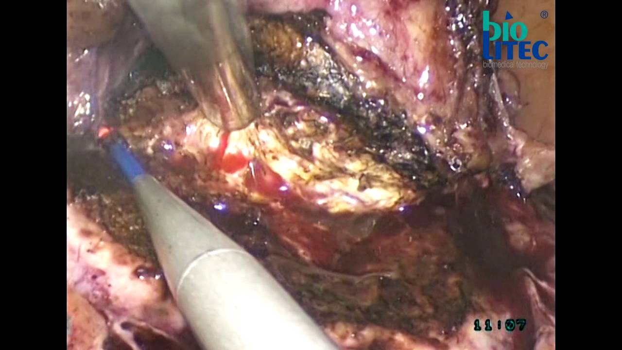 biolitec&reg; medical laser:Laparoscopic laser partial nephrectomy