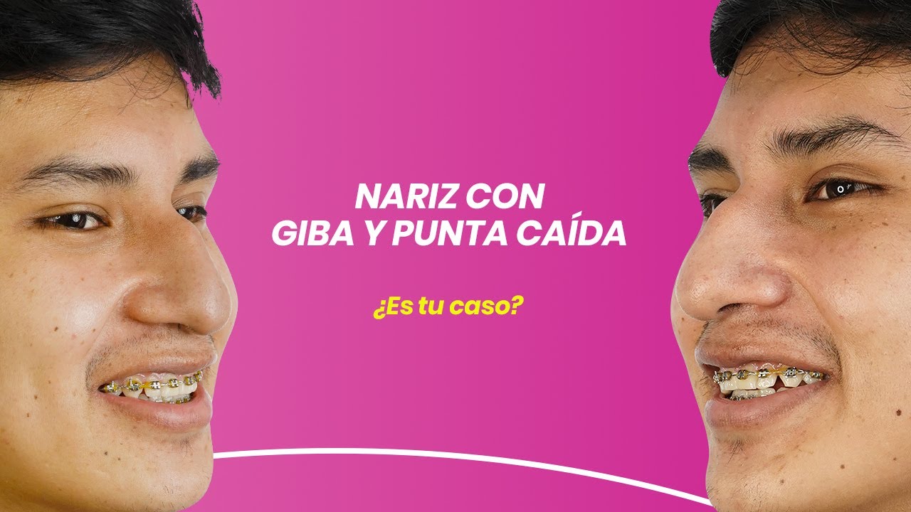 NARIZ CON GIBA Y PUNTA CAÍDA ¿ES TU CASO?
