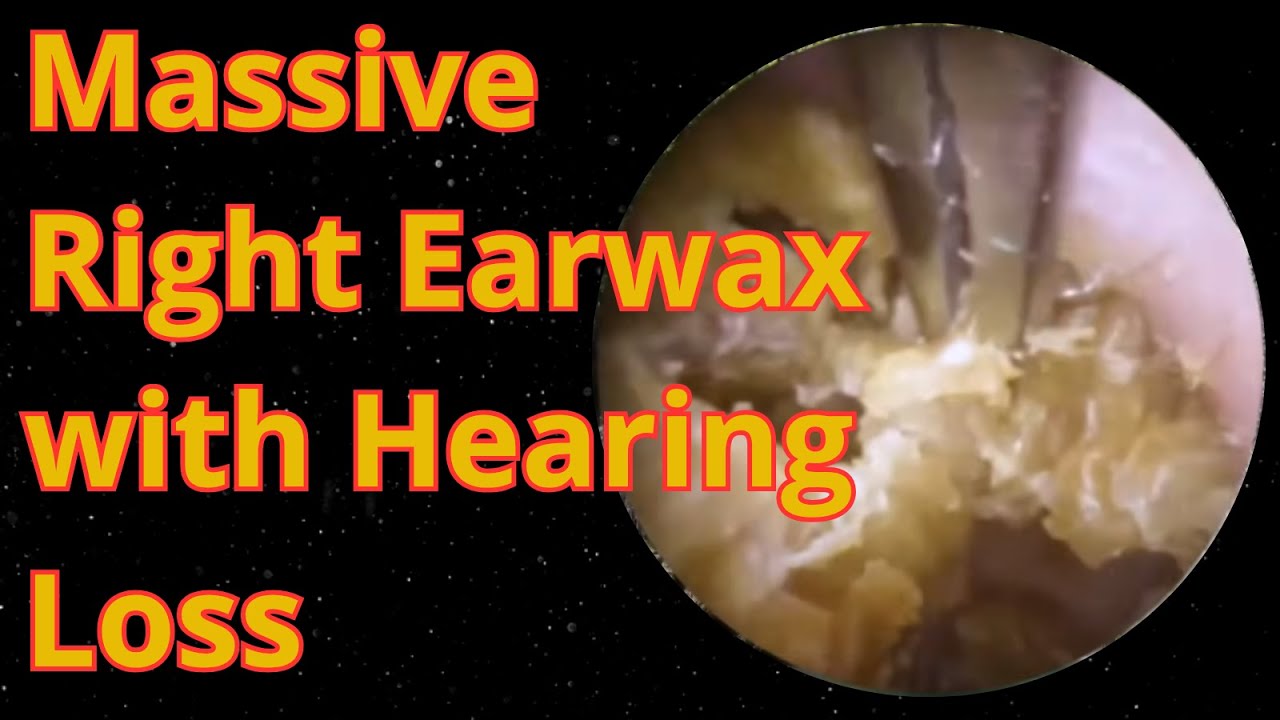 Massive Right Earwax with Hearing Loss - Earwax Removal Compilation