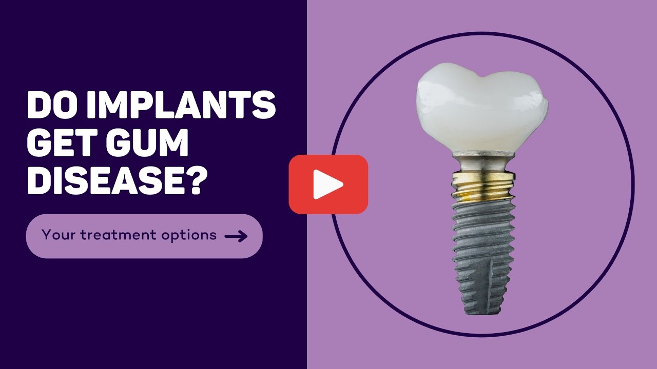 Do Dental Implants Get 