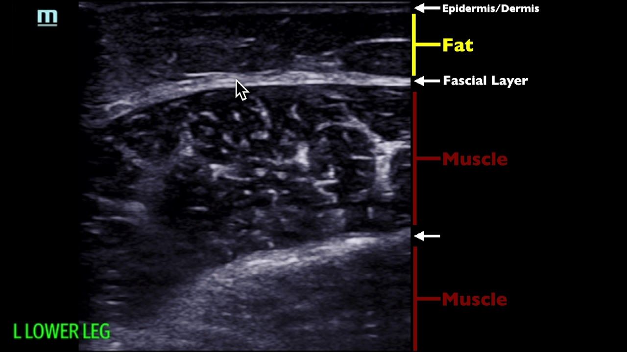 POCUS - Soft Tissue Ultrasound - Soft Tissue Edema