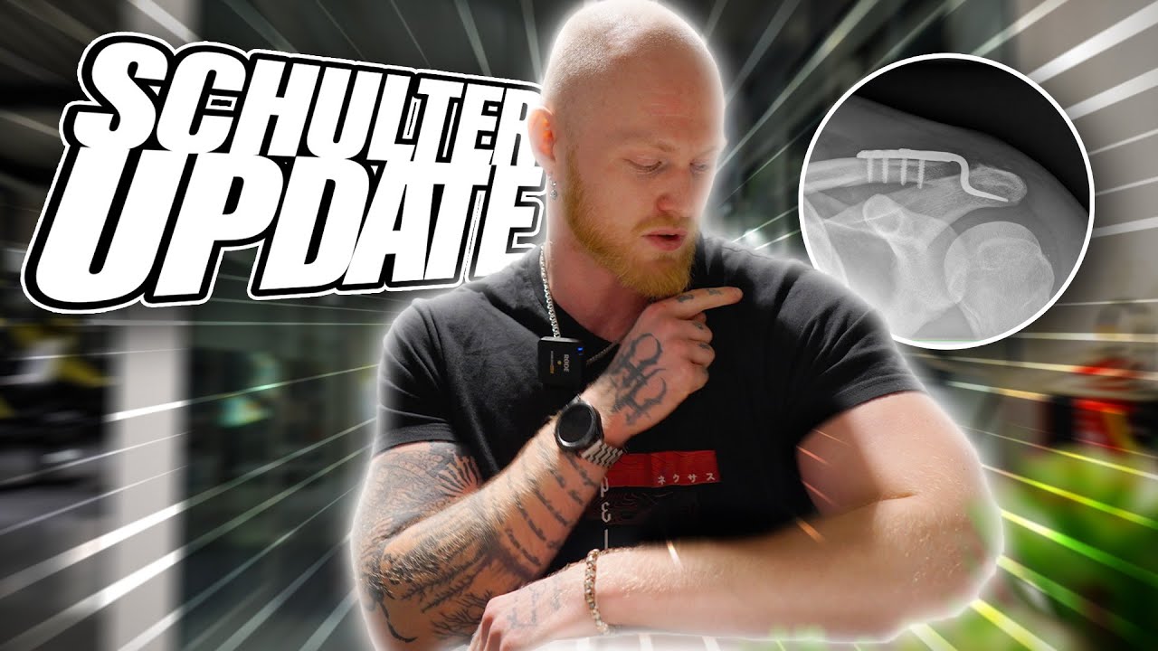 UPDATE zu meiner SCHULTER kurz vor der OP! (Schultereckgelenksprengung)