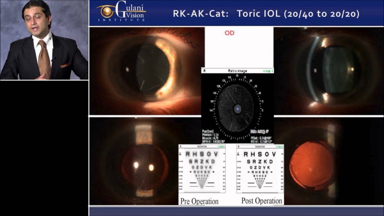 Dr. Gulani's Case Studies With the OPD-Scan III