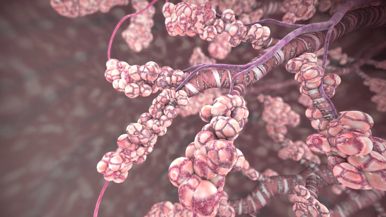 How COPD Affects the Lungs