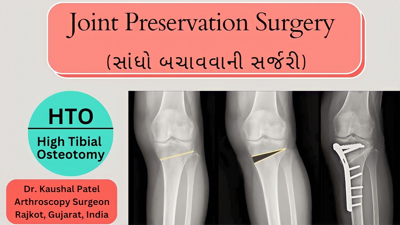 What is High Tibial Osteotomy? | HTO - Joint preservation surgery #kneepreservation #kneepain
