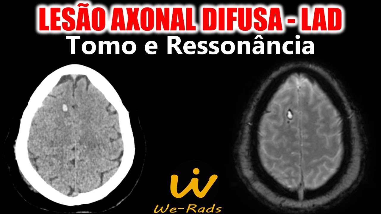 Lesão Axonal Difusa (LAD) - Tomografia e Ressonância