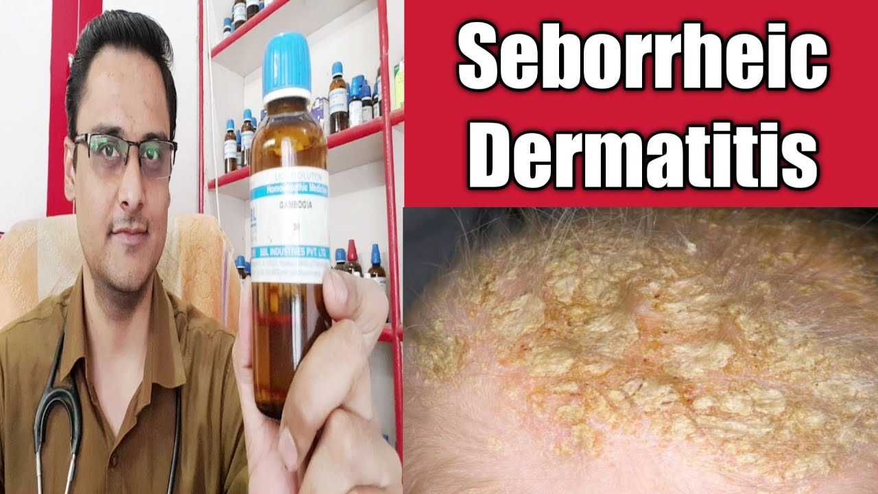 Seborrheic Dermatis- itchy scalp ! सिर में खुजली psoriasis eczema homeopathic medicine