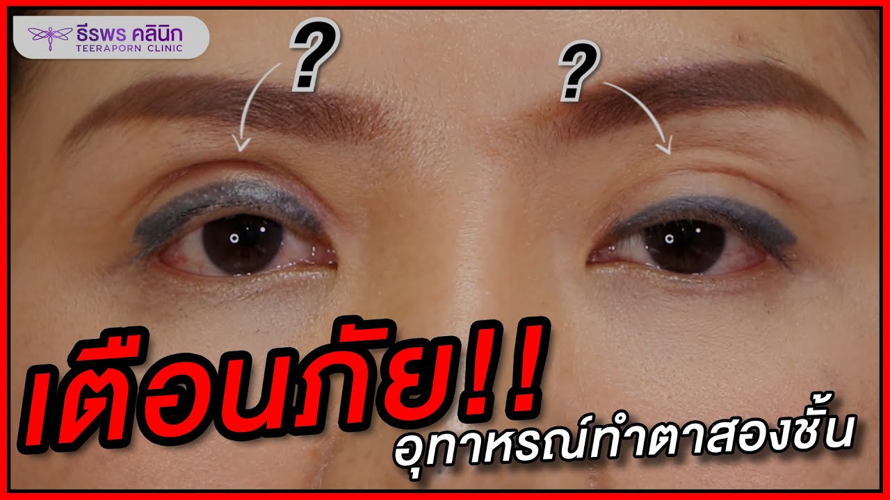 เตือนภัย อุทาหรณ์การทำตาสองชั้น จากตาปกติกลายมาเป็น???
