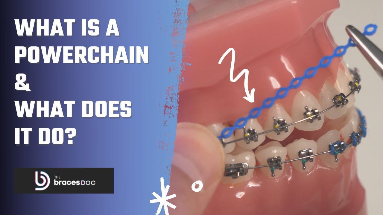 What is a Powerchain | How do Powerchains Work with Braces | How do braces work? TheBracesDoc l