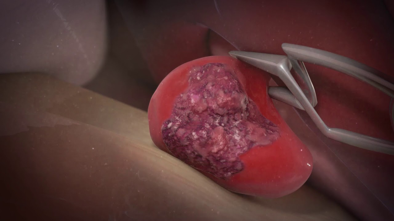 Medische animatie over een subarachno&iuml;dale bloeding (SAB) in de hersenen