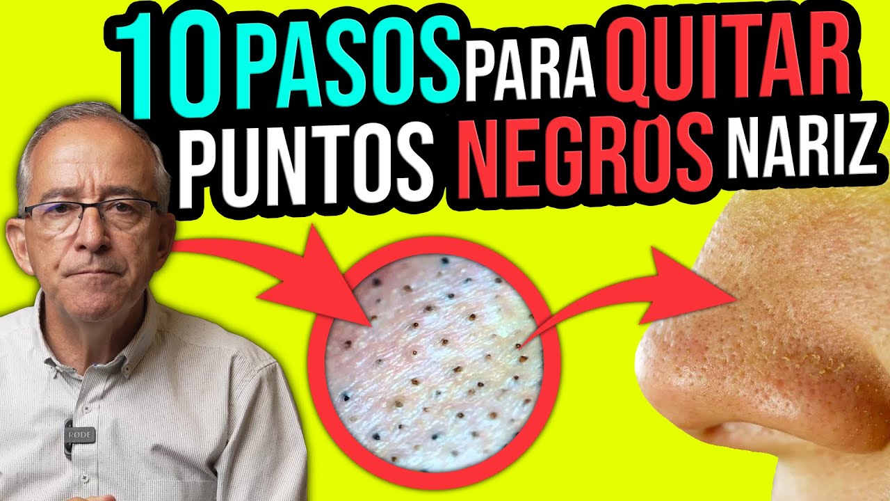 INCREIBLE ASI SE QUITAN LOS PUNTOS NEGROS DE TU NARIZ - Oswaldo Restrepo RSC