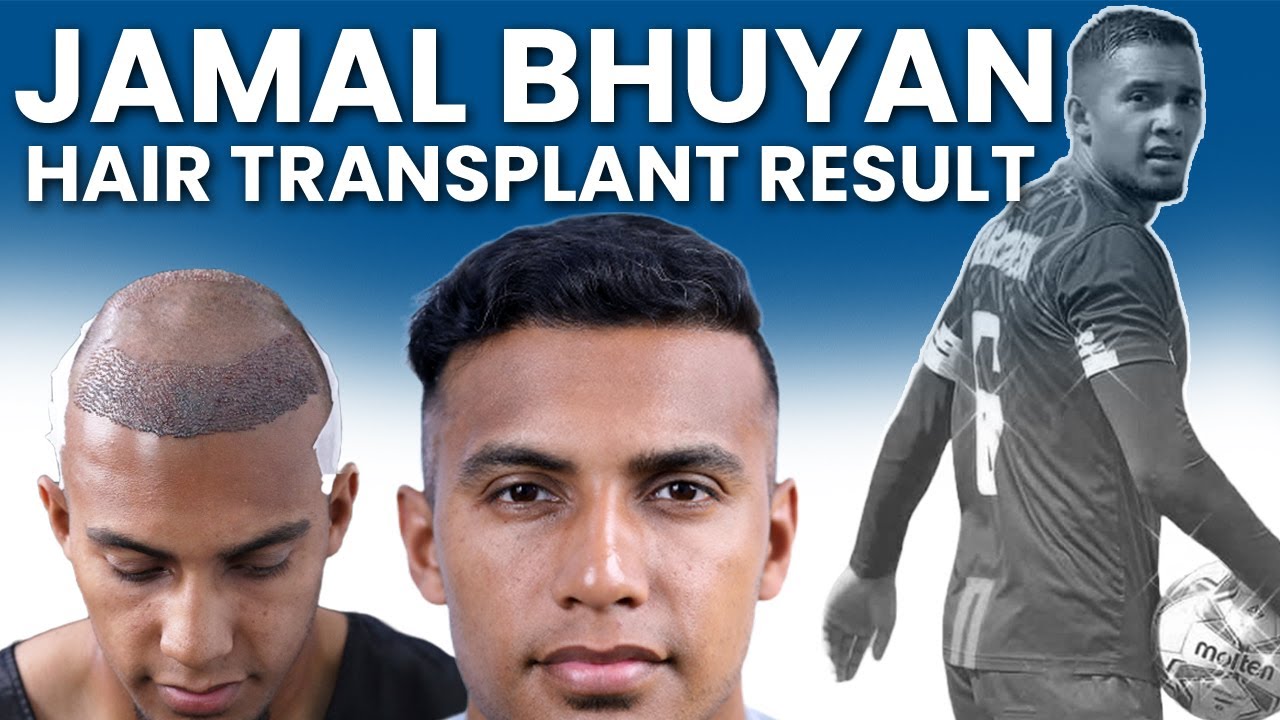 Jamal Bhuyan Hair Transplant Result | Hair Transplant Cost Bangladesh |