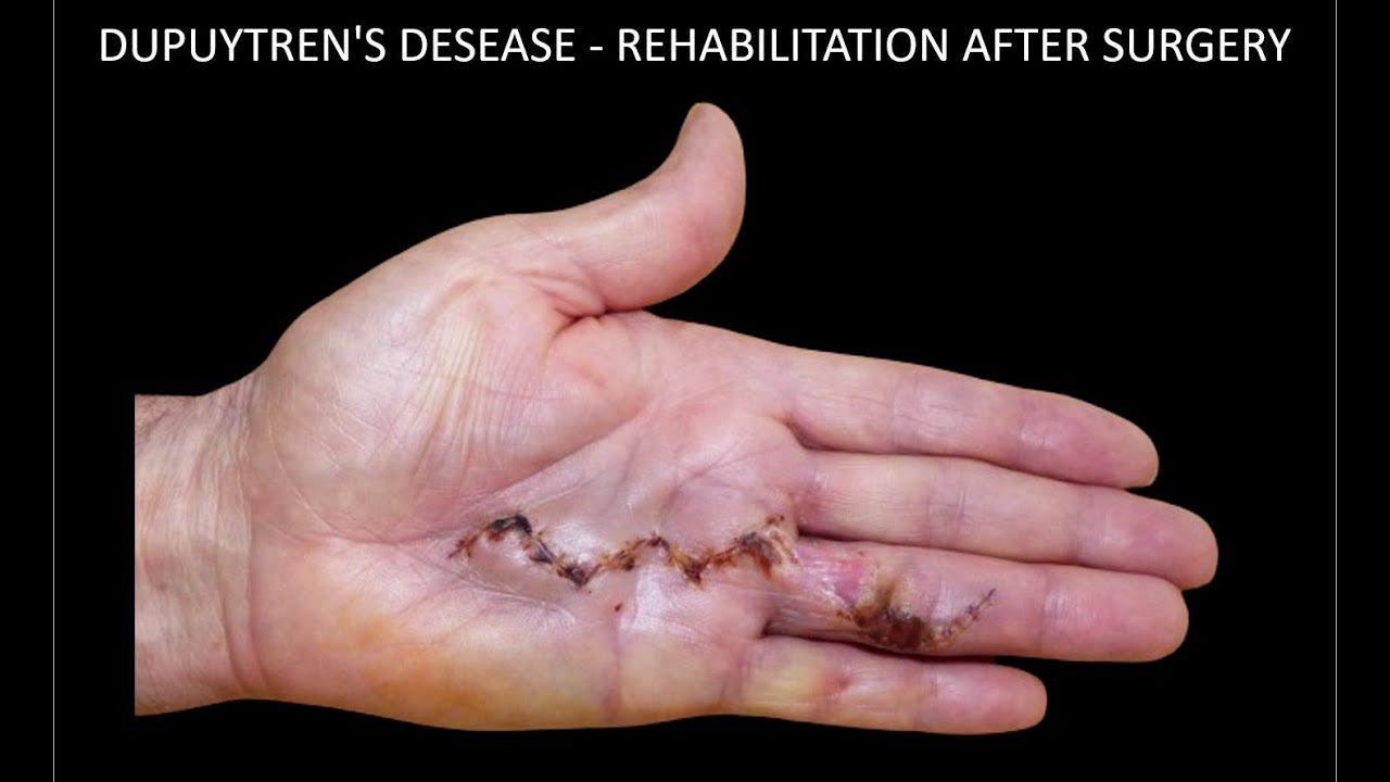 DUPUYTREN'S DESEASE - REHABILITATION AFTER SURGERY