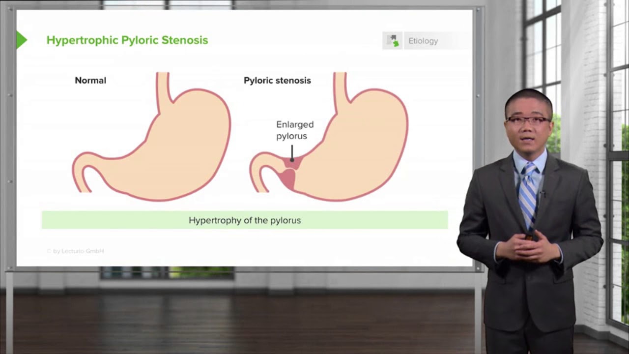 Hypertrophic Pyloric Stenosis Surgery