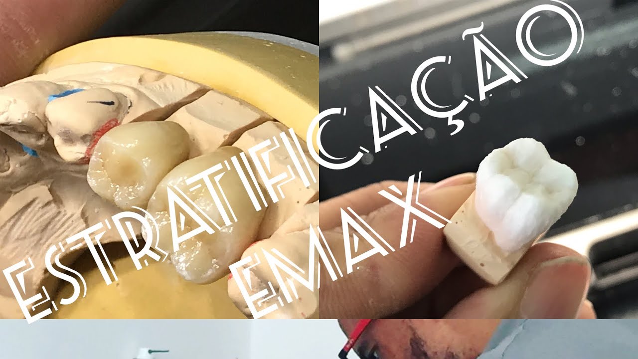 Estratificação de Emax- com 2 massas e 2 stains