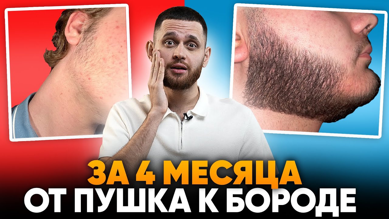 Результаты за 4 МЕСЯЦА в 17 лет / Лосьон для роста бороды mr. Volos
