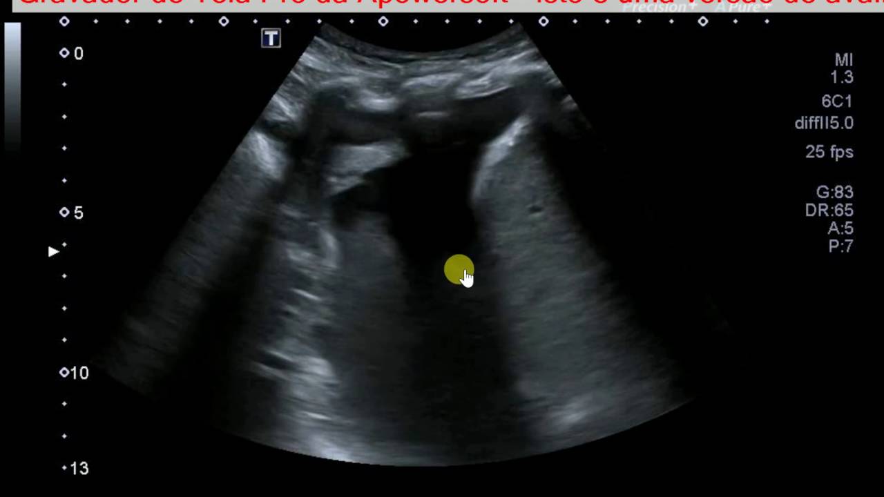 Derrame pleural - Ultrassonografia pulmonar - Dr. Marco Guedes