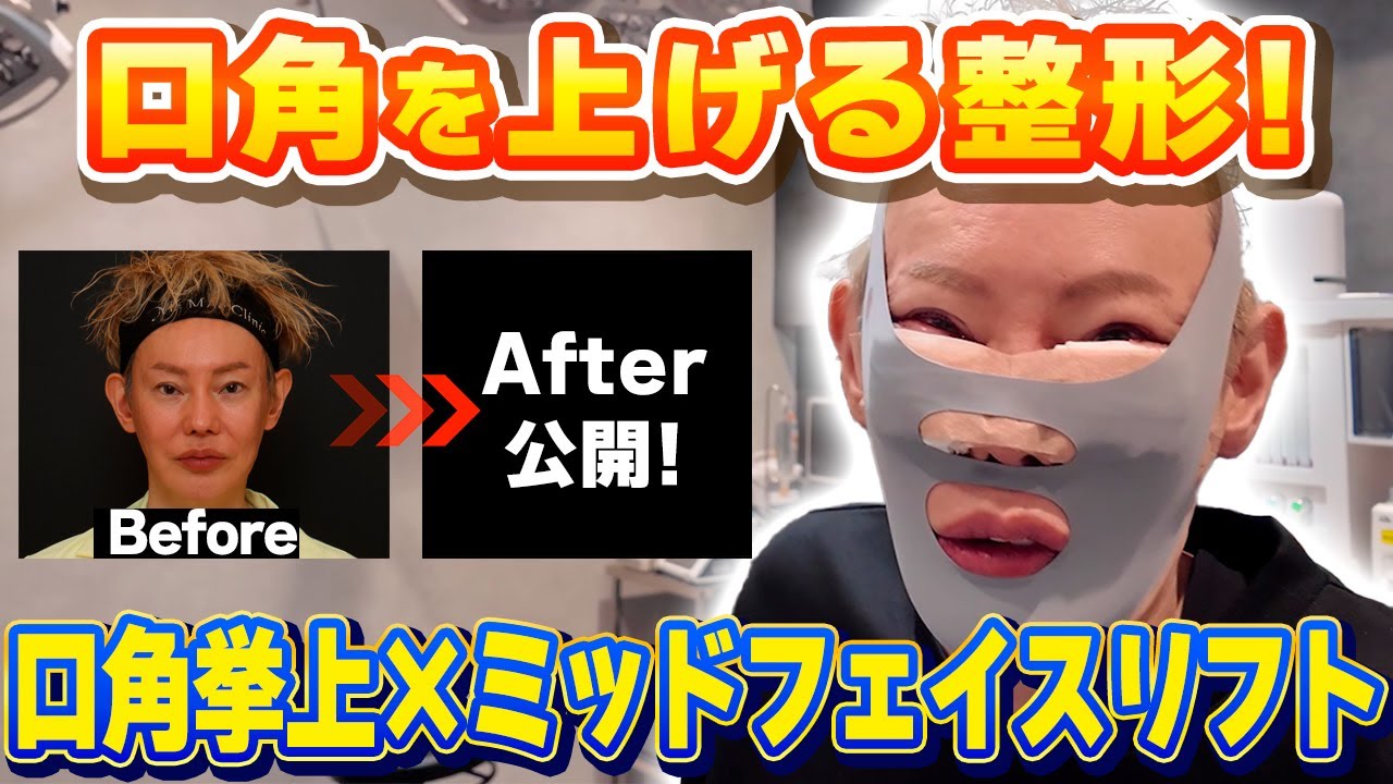 【整形】口角を上げる整形！まえしょー先生オペ当日