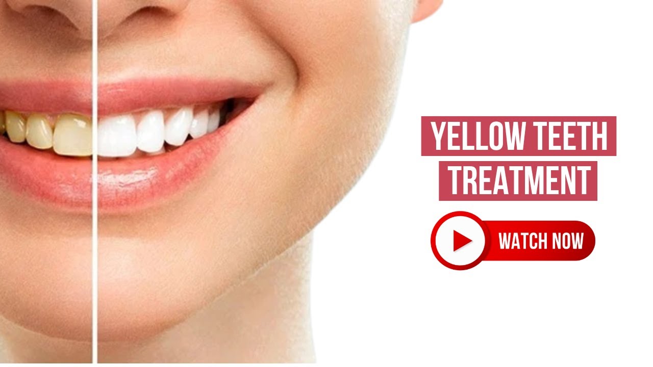 Yellow Teeth Treatment | Tips to Whiten Teeth and Avoid Common Mistakes | Royal Dental Clinics