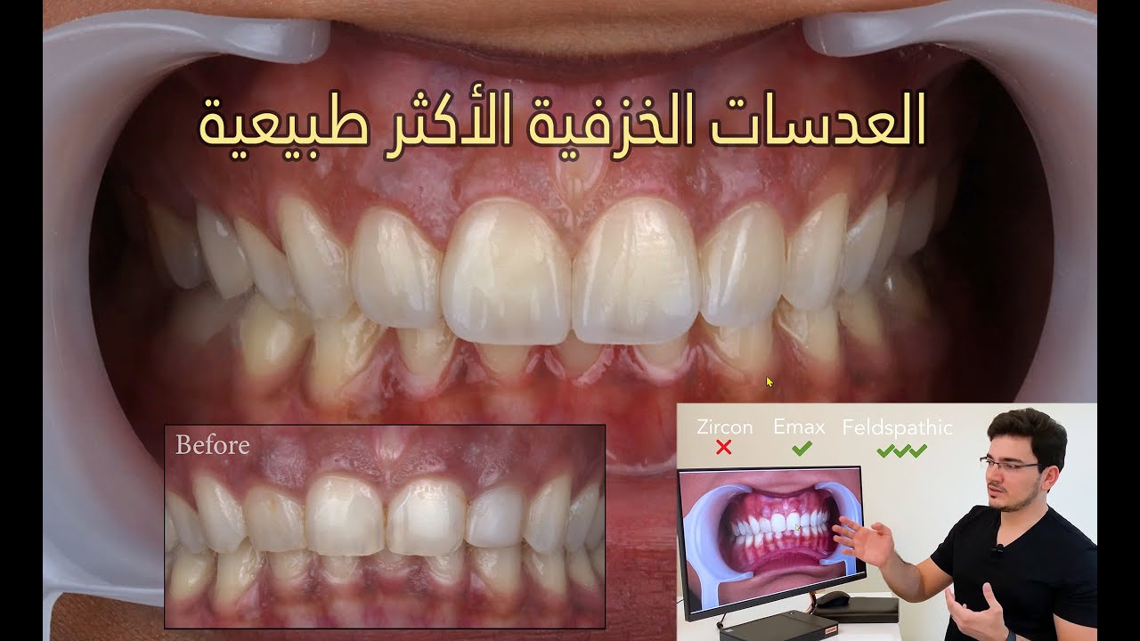 Feldspathic Veneers العدسات الخزفية المطابقة للأسنان الطبيعية