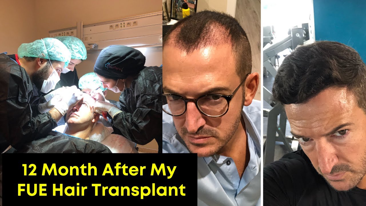My Hair Transplant Update - 13 Month After FUE Transplant in Turkey. Am I happy?? What went wrong!