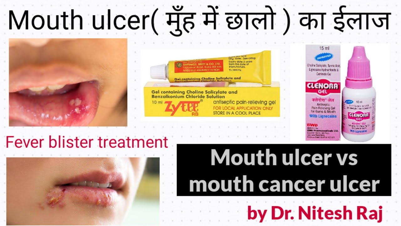 मुँह में छालो का ईलाज.Fever blister vs Mouth ulcer.Mouth ulcer vs mouth cancer ulcer by Drniteshraj