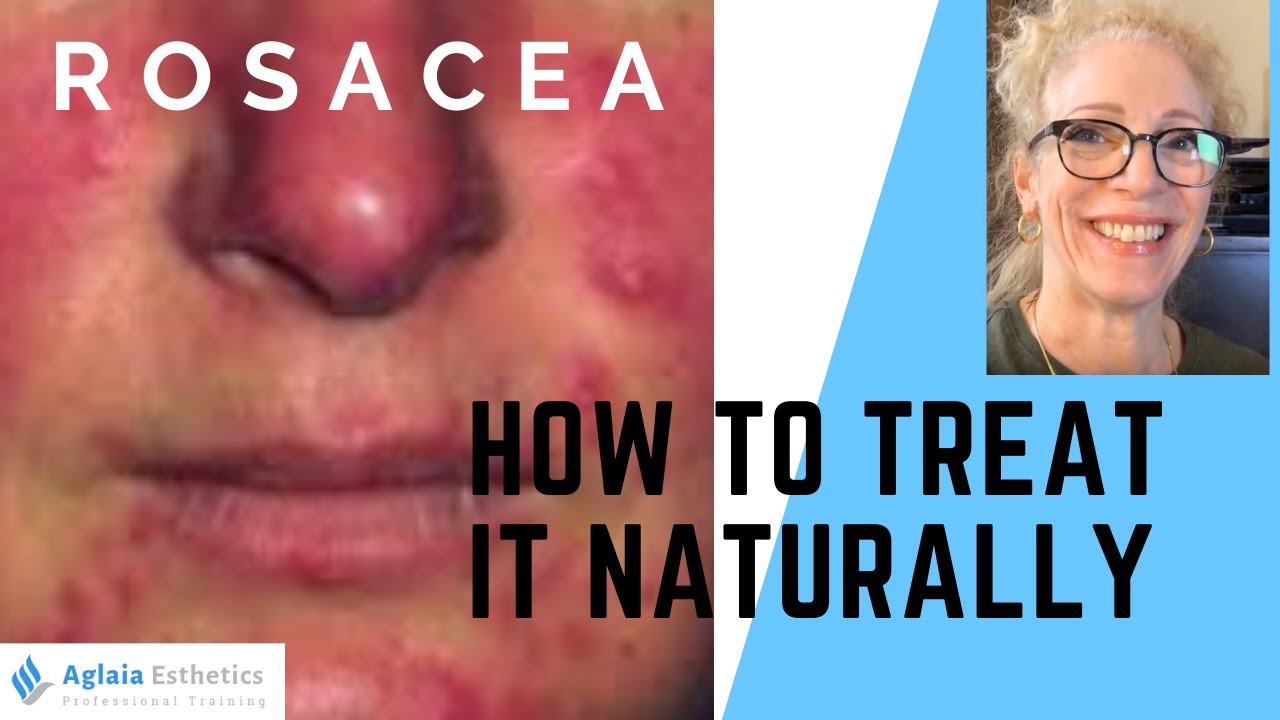 ROSACEA RELIEF: How To Treat Naturally!
