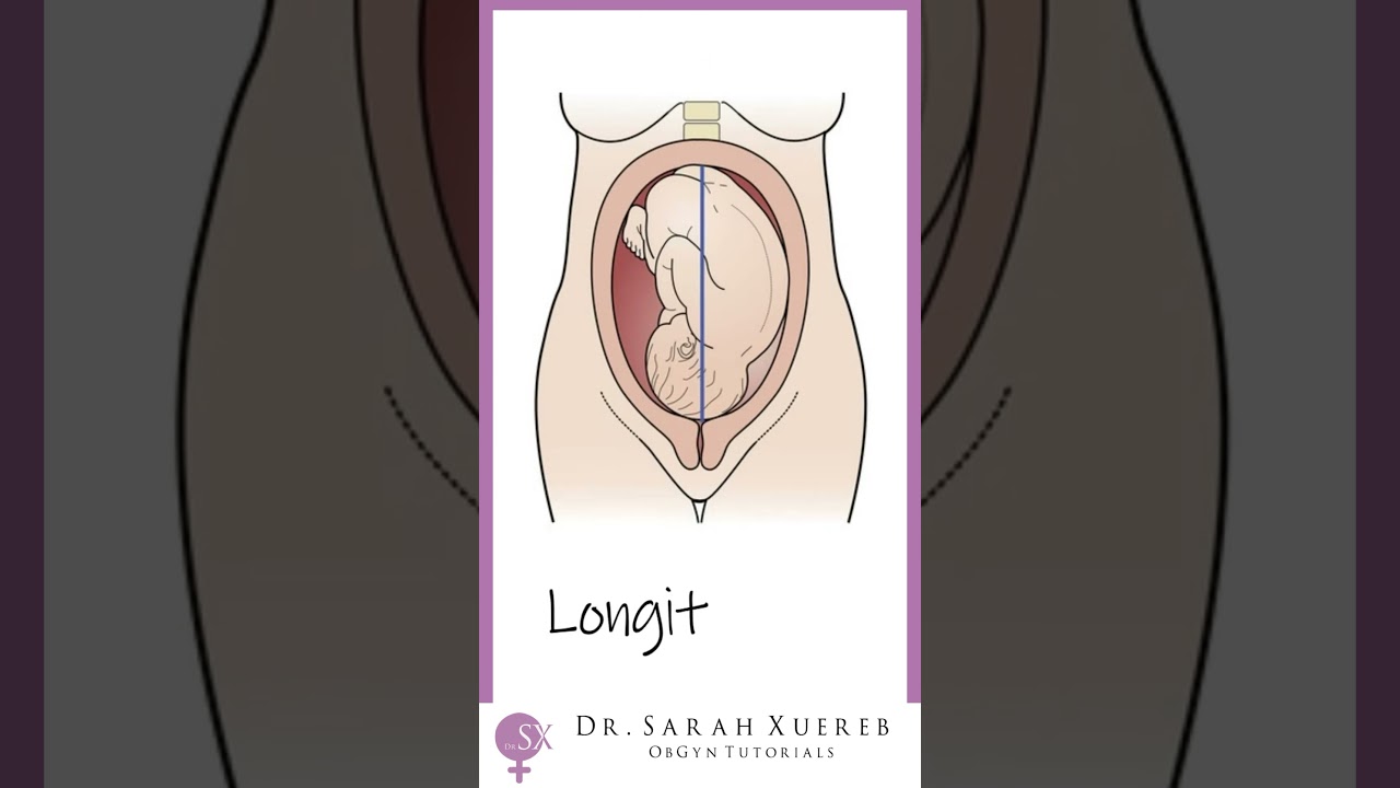 Fetal Lie