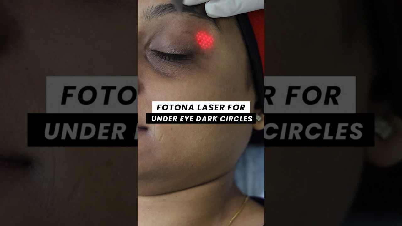 Fotona Laser for Under eye Dark Circles | ClearSkin Pune