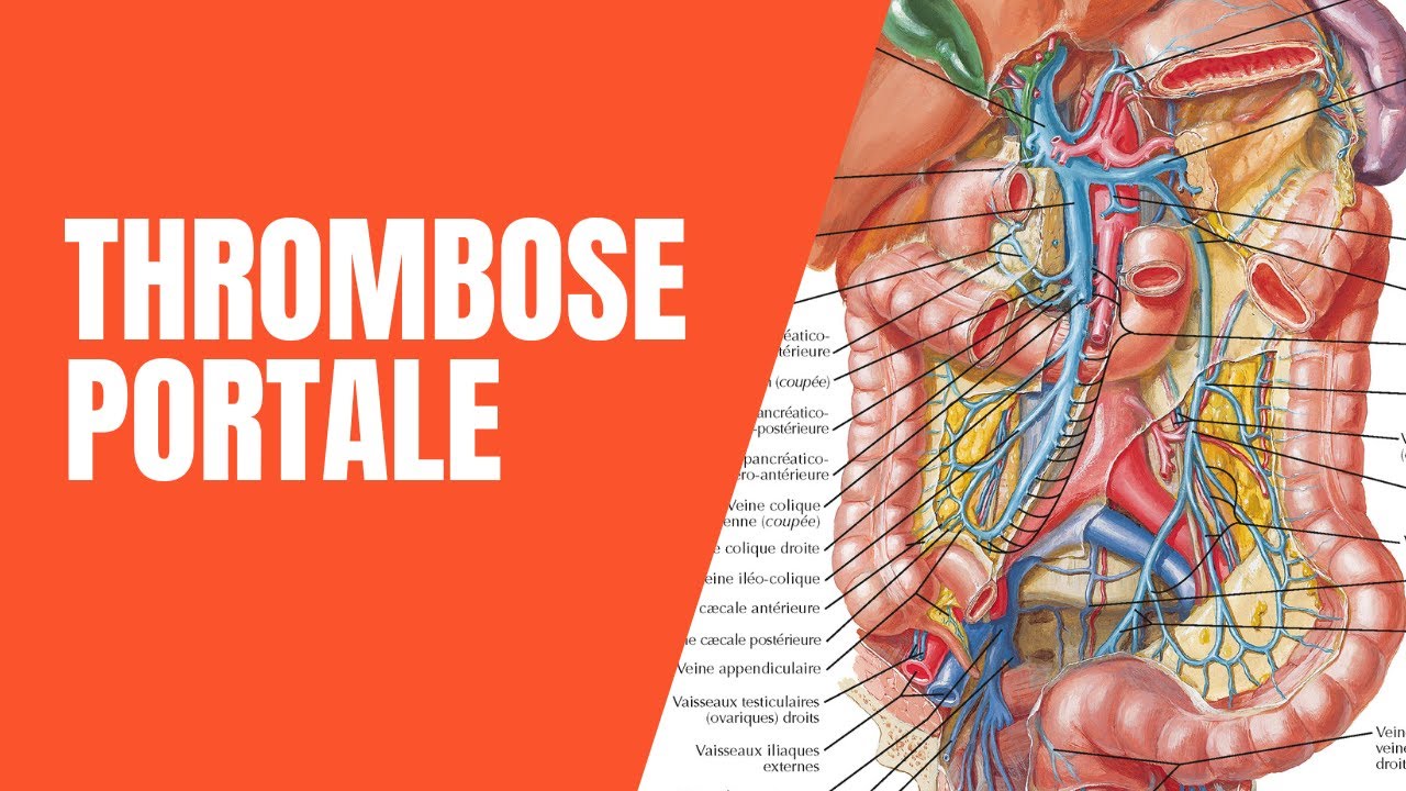 Thrombose portale aigue - Cours médecine radiologie imagerie
