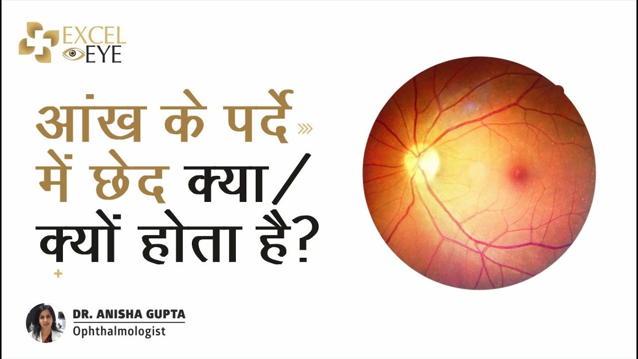 आँख के पर्दे मे छेद  क्या/क्यों  होता है? Dr Anisha Gupta - Eye Specialist in Delhi