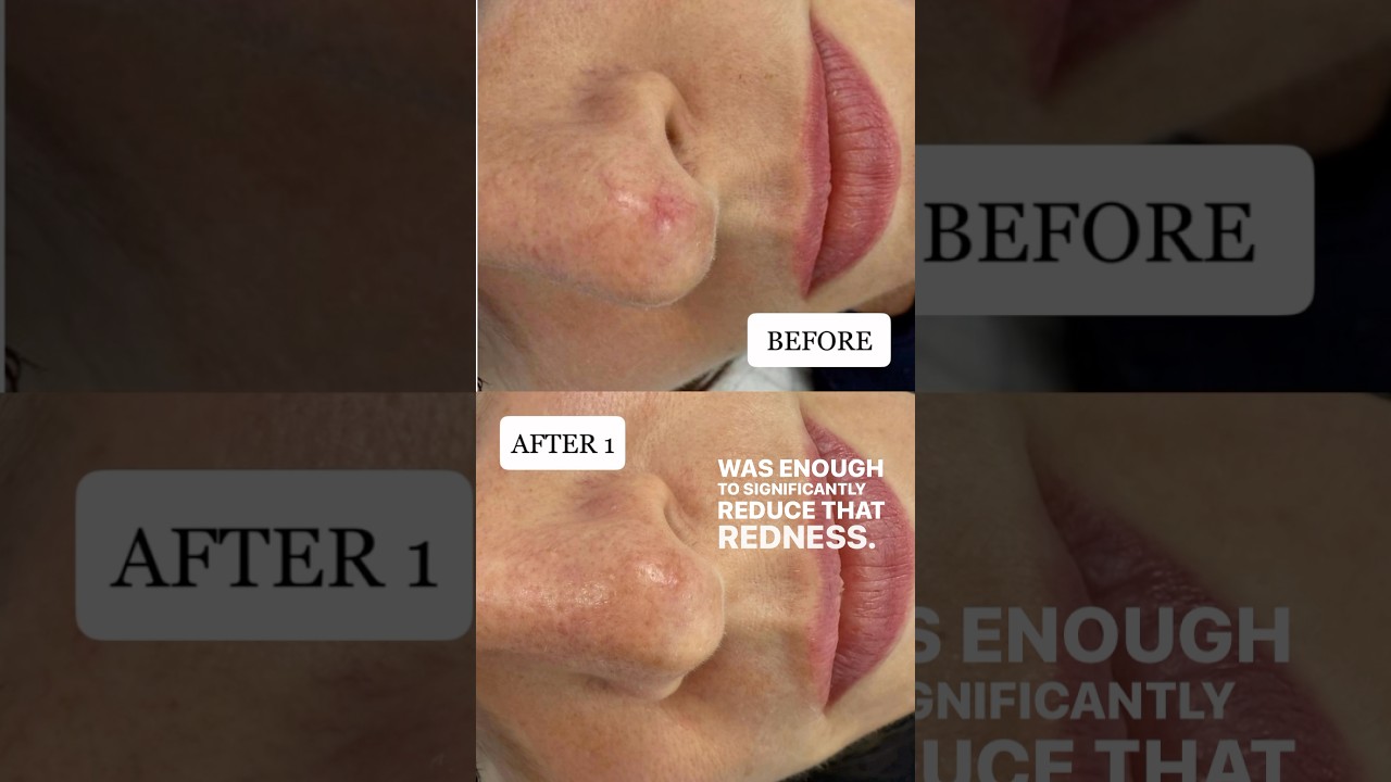 RED VEIN REMOVAL RESULTS &bull; BEFORE & AFTER 1 TREATMENT OF ELECTROCAUTERY!