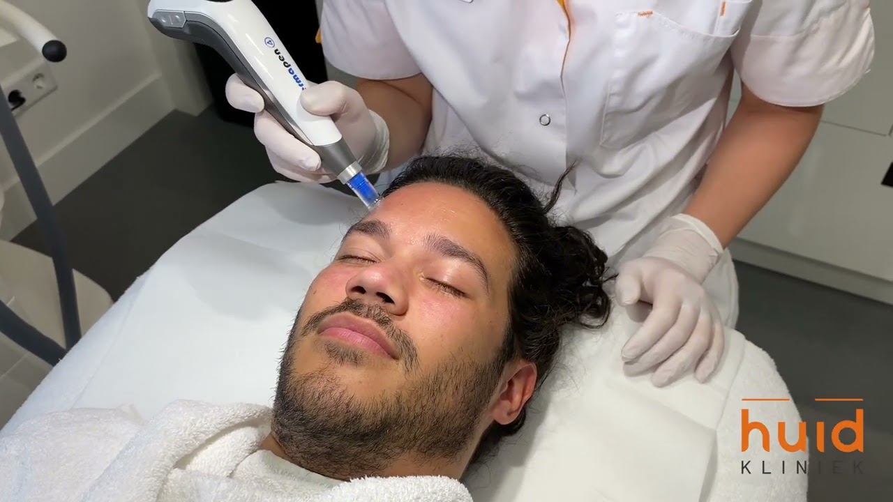 Microneedling - De Huidkliniek