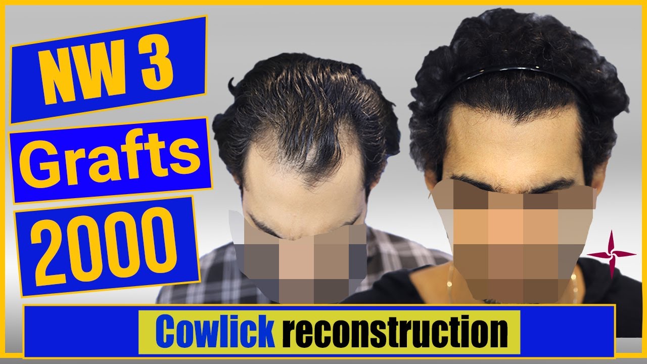 Cowlick Hair Transplantation And Reconstruction, Grade 3 @Eugenix by Drs Sethi & Bansal