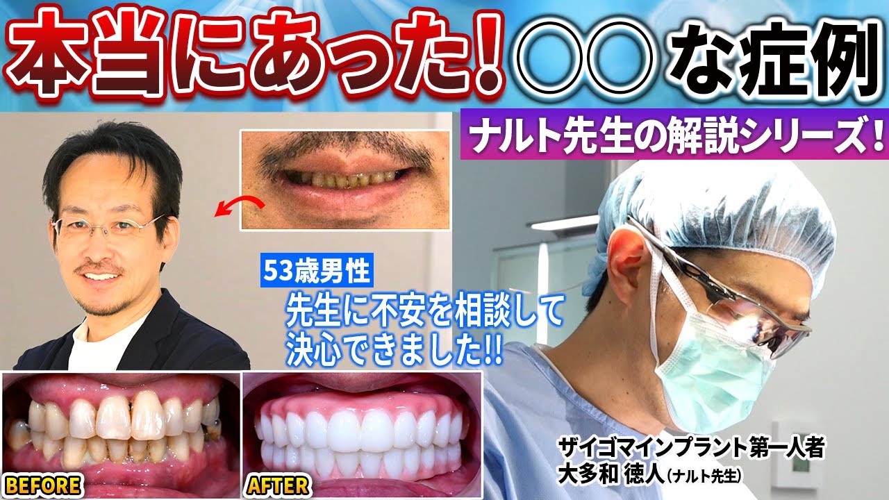 歯がボロボロで膿も出てきた…オールオン4にするかインプラントにするかナルト先生に相談して決意しました！オールオン4で本当によかった！本当にあったシリーズ