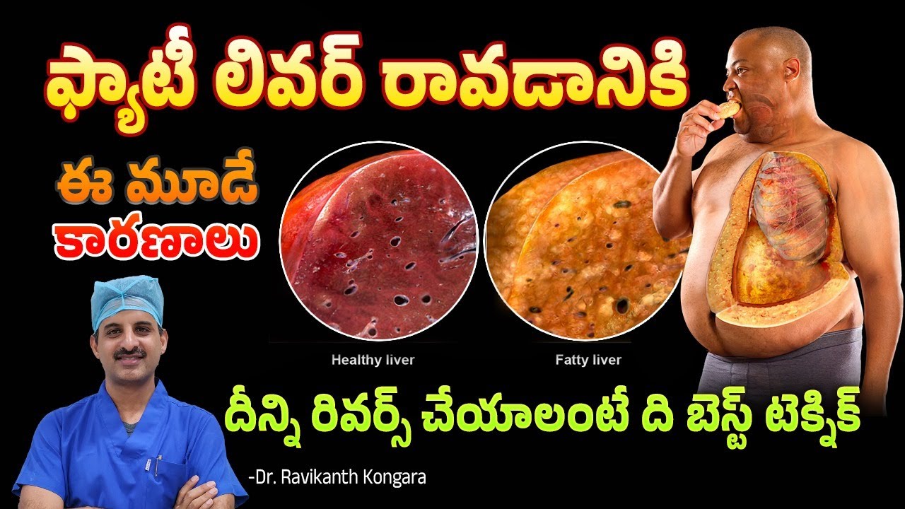 Causes of Fatty Liver | How to Treat Fatty Liver | Avoid Alcohol | Obesity | Dr. Ravikanth Kongara