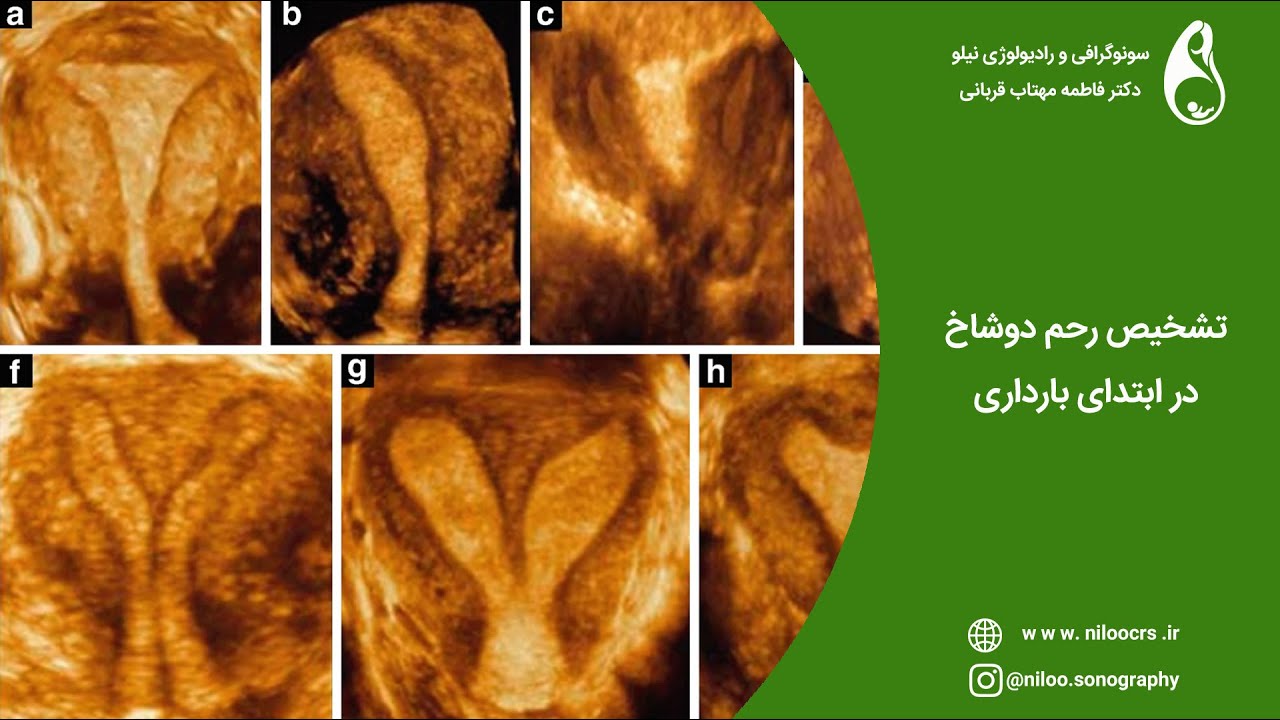تشخیص رحم دو شاخ در ابتدای بارداری
