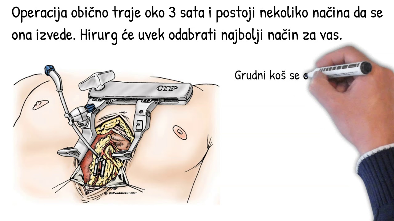 Šta je bajpas hirurgija
